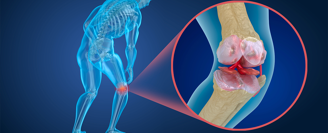 Diagram of knee joint with osteoporosis