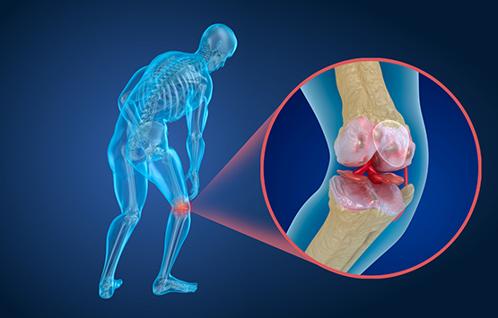 Diagram of knee joint with osteoporosis
