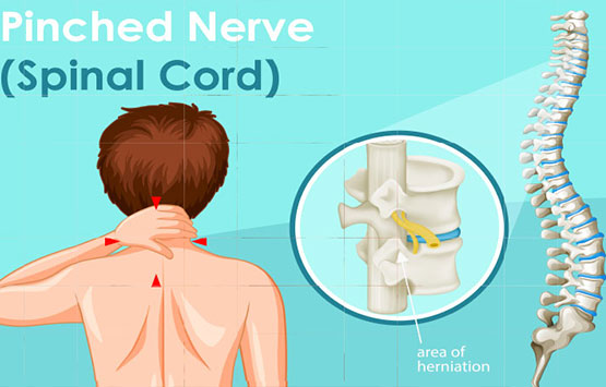 Diagram of pinched nerve in neck