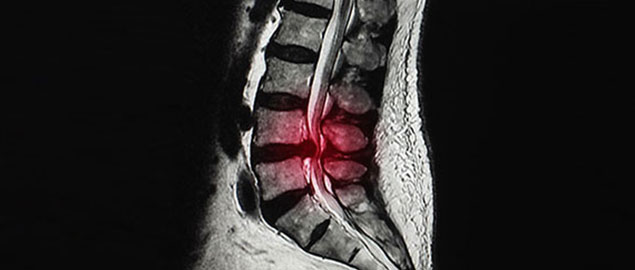 herniated disc chiropractor in San Rafael, CA