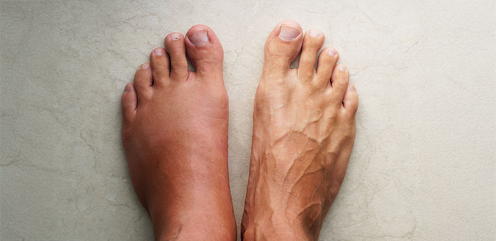 patient needing complex regional pain syndrome treatment in San Rafael