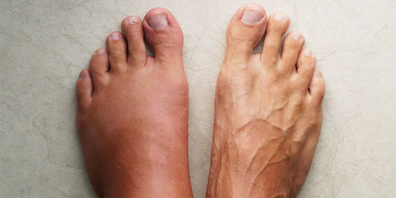 complex regional pain syndrome Treatment in San Rafael