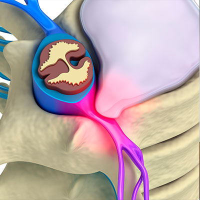 Diagram of herniated disc in San Rafael