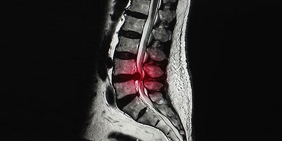 disc injury Treatment in San Rafael