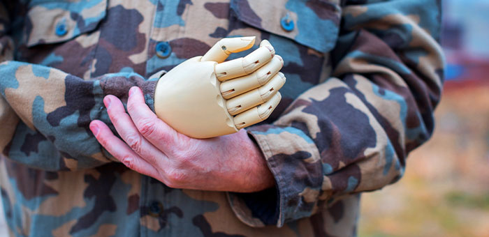 patient needing phantom limb syndrome treatment in San Rafael