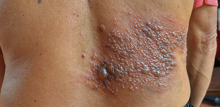 patient needing post herpetic neuralgia treatment in San Rafael