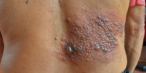 post herpetic neuralgia Treatment in San Rafael