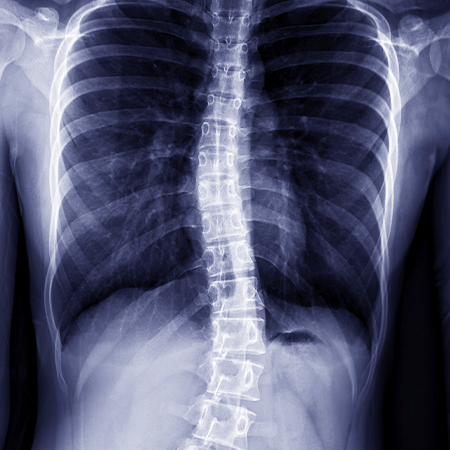 X-ray of spine with scoliosis in need of chiropractic care in San Rafael